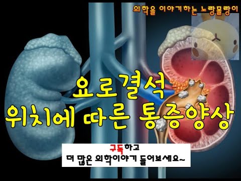 요로결석(urinary stone): 요관결석, 신장결석 위치와 통증양상: renal colic(산통)