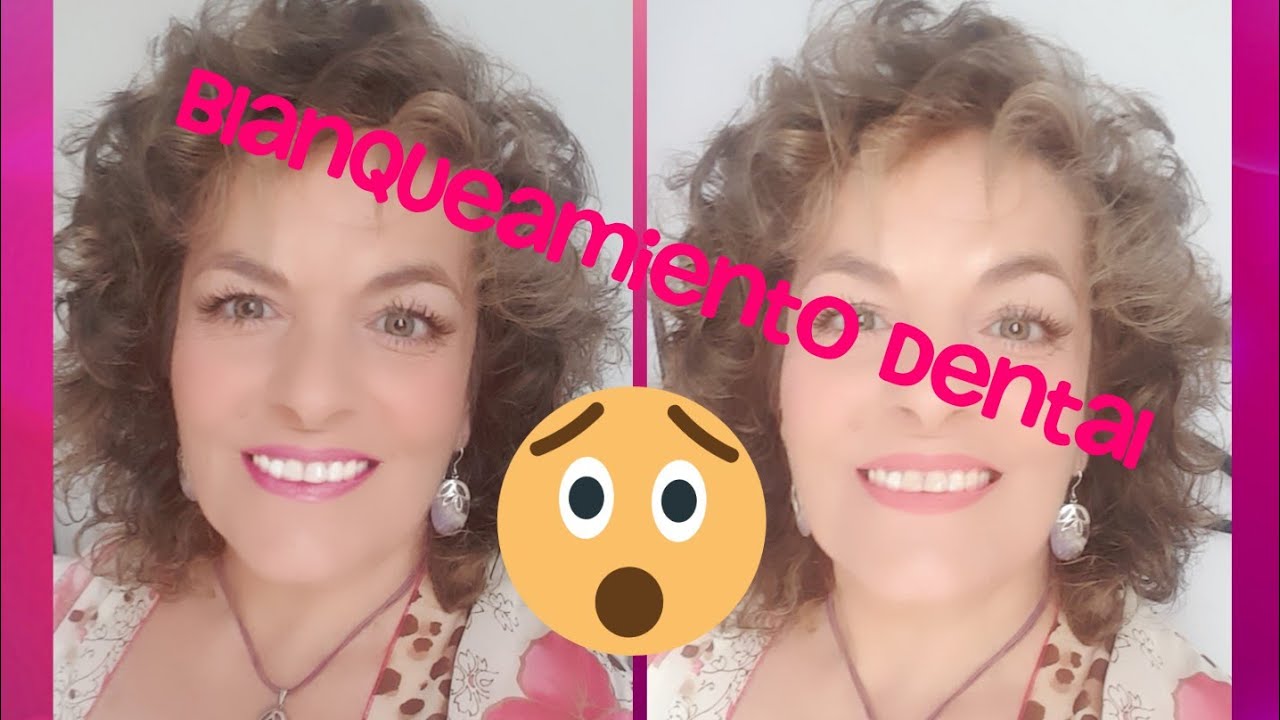 manualidades raudales Blanqueamiento Dental