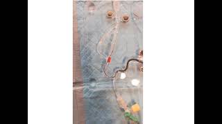 Contact Aspiration Thrombectomy: Simulation using a 60-ml syringe pump