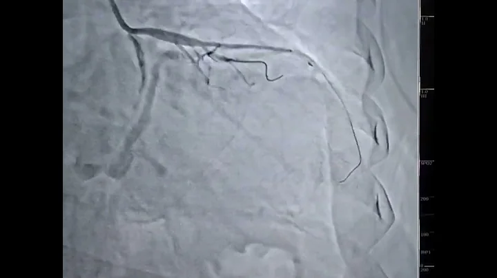 PCI to LAD Diag bifurcation provisional