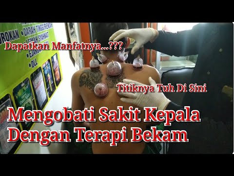 Cara Mengobati Sakit Kepala Dengan Terapi Bekam | Mengobati Migrain