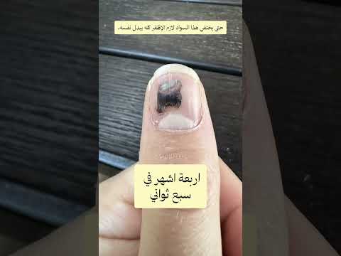 اللون الأسود الي تشوفه تحت الأظفر هو نزف دموي  