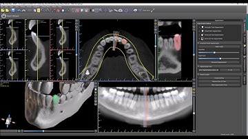 Automatic Tooth Extraction