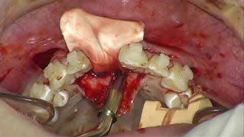 TENTING Technique for Guided Bone Regeneration – Dr. Robert Carvalho da Silva