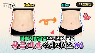 [복부지방흡입] 뱃살빼기👌 통허리 교정 👌 [레아트성형외과]