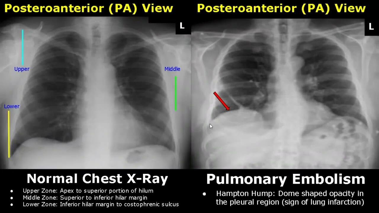 Pneumothorax Vs Pleural Effusion Chest X Ray Sexiezpicz Web Porn