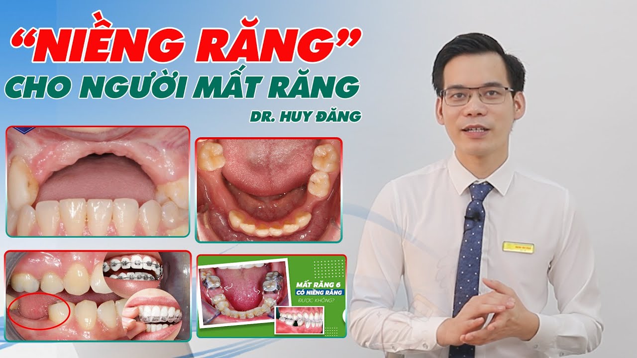 Outline Video Người mất răng có " Niềng Răng" được không? Ưu điểm & khó khăn khi niềng răng cho người mất răng?
