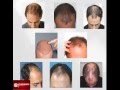 Clinicspots  hair transplant  patients story