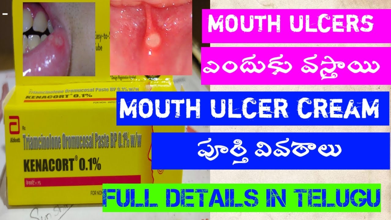 MOUTH ULCER CREAM USE AND SIDE AFFECTS IN TELUGU YouTube MOUTH ULCER CREAM USE AND SIDE AFFECTS IN TELUGU YouTube