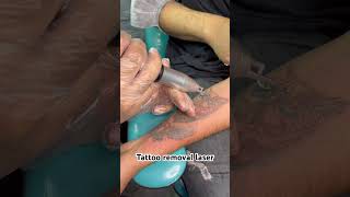Removing Tattoos With Laser