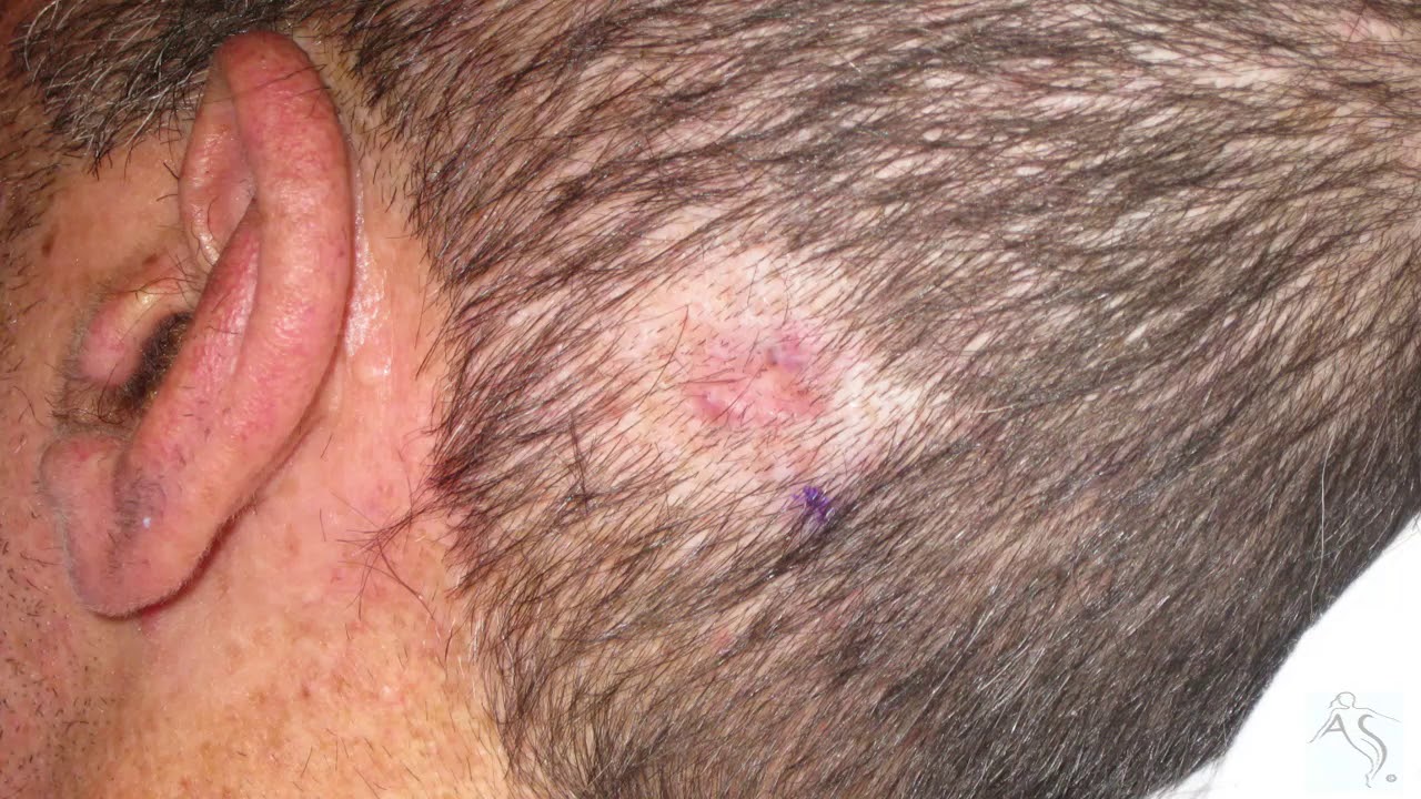 basal cell carcinoma of the scalp - YouTube