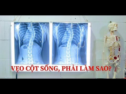 Video: Làm thế nào để loại bỏ tóc mỏng: 15 bước (có hình ảnh)