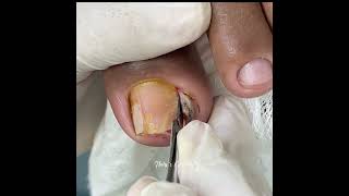 satisfying unhaencravada nails ingrown_toenail podologanatyscarvalho podologia