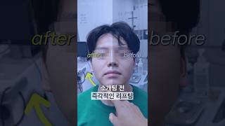 즉각적인 효과를 보여주는 리프팅이 있다?