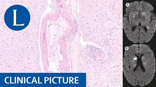 SLE and antiphospholipid syndrome: a difficult combination