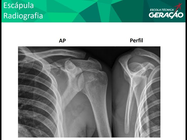 Radiografia de Escápula : AP + Perfil 