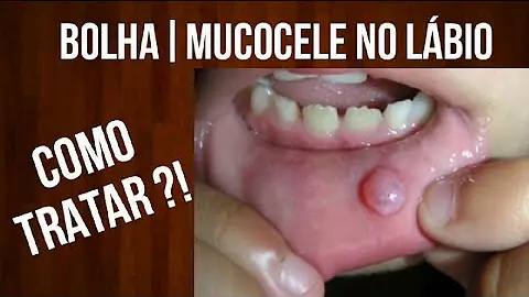 O que pode ser uma bolha na boca?