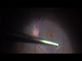 Macular hole management with dhamis diamond dusted forcep a new innovation