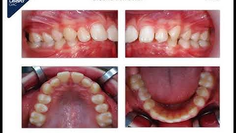 BBC - Bio Bite Corrector