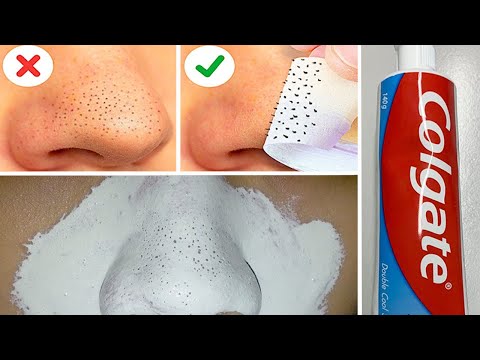 In Just 5 Mints Best Way to Remove BLACKHEADS With Toothpaste/ Toothpaste for Remove BLACKHEADS