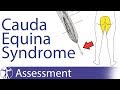 Cauda Equina Syndrome | Signs & Symptoms