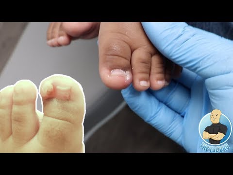 Video: Baby Ingrown Toenail: Orsaker, Symptom, Behandlingar, Mer