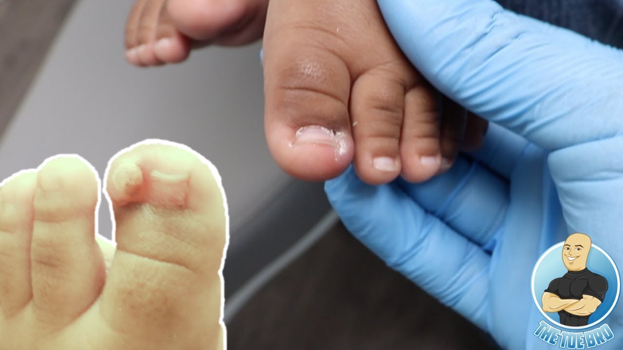 Baby ingrown toenail | BabyCentre