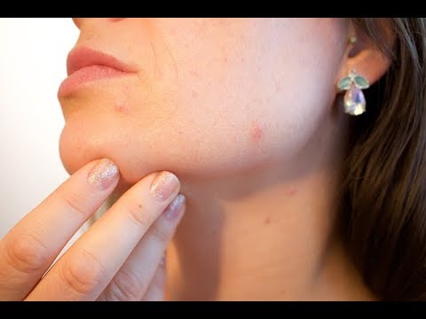 Acne Solution: How I Overcome acne after several years: (Natural cure for Pimples)