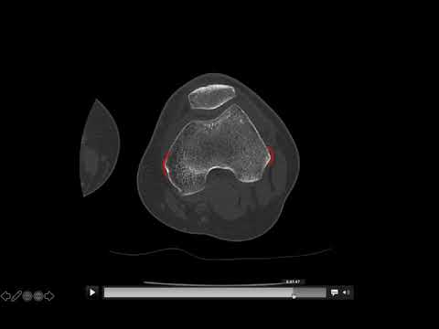 Anatomía CT Rodilla