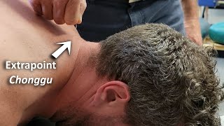 A Proprioceptive Acupuncture Technique at Extrapoint Chonggu screenshot 5