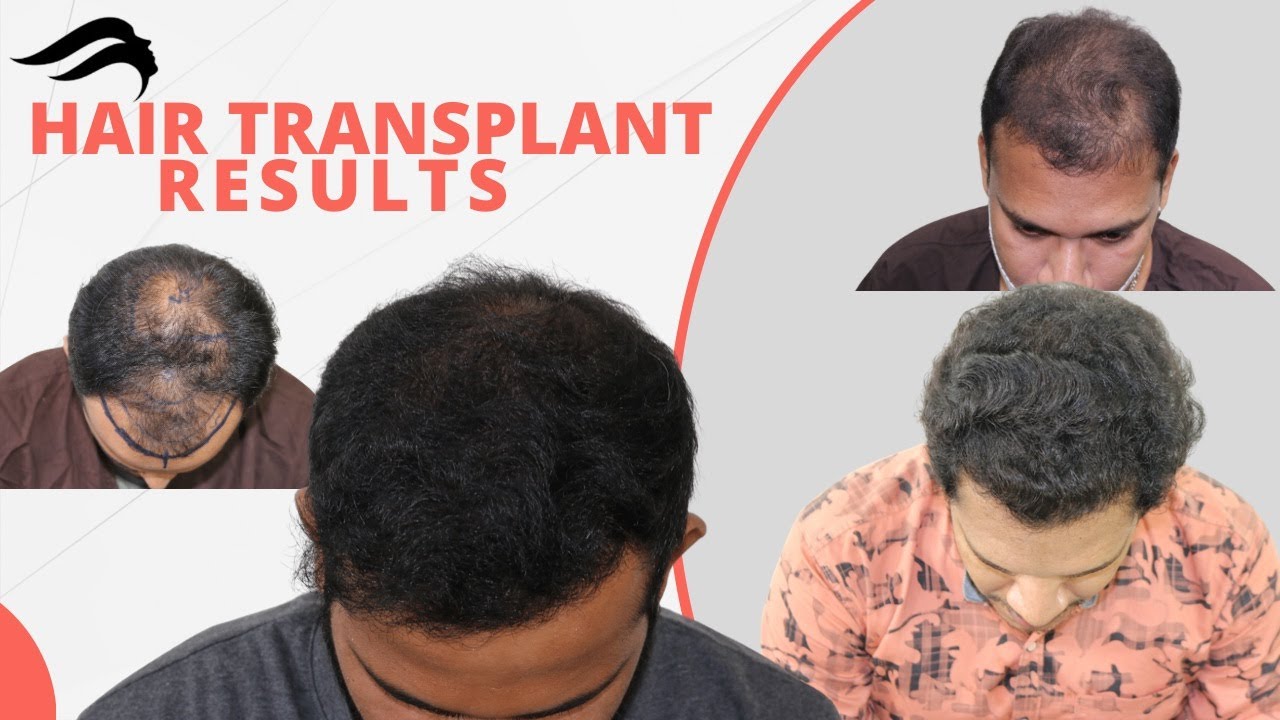 Hair Transplant In Chennai Best Results With Best Cost Of Hair