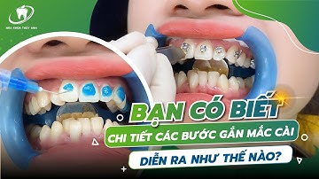 KĨ THUẬT GẮN MẮC CÀI CHO TỪNG TRƯỜNG HỢP KHI NIỀNG RĂNG