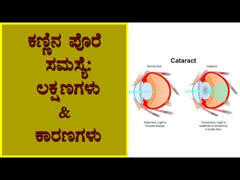 Cataracts: Symptoms and causes | Vijay Karnataka
