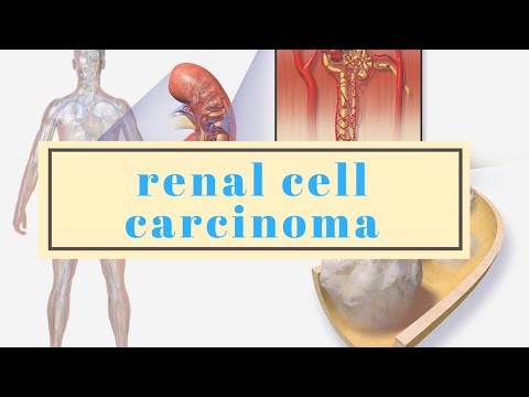 Renal Cell Carcinoma Prognosis Life Expectancy and Survival Rates