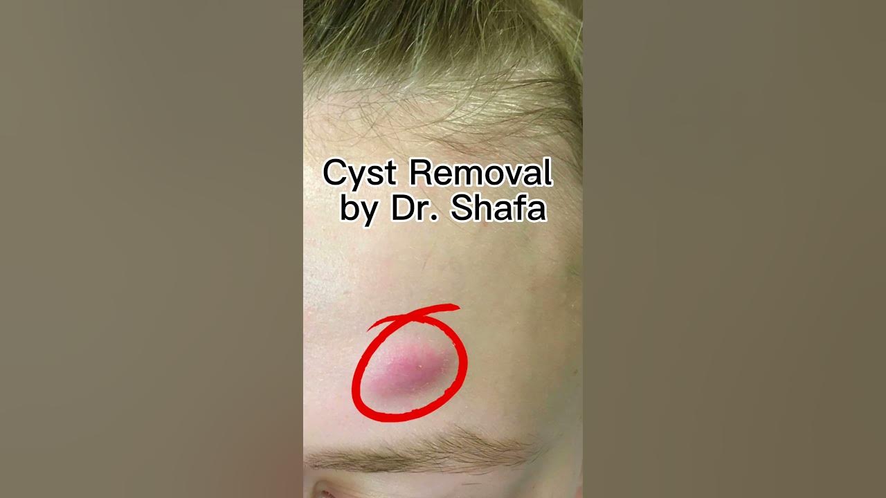 cyst-removal-by-dr-shafa-at-oc-medderm-dermatology-dermatologist