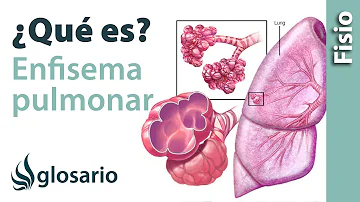 ¿Cuáles son los primeros síntomas de enfisema pulmonar?