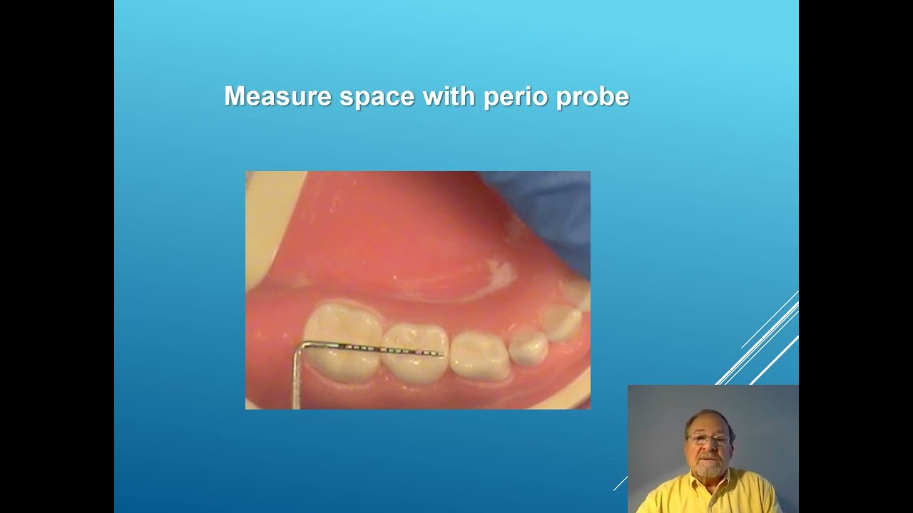 Posterior Strip Crowns Video