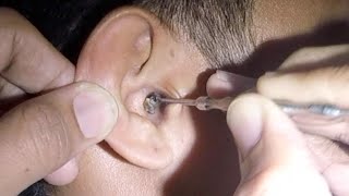 Removing HUGE Earwax Flake Stuck in Man's Ear by Earwax Specialist 65,917 views 3 weeks ago 1 minute, 2 seconds