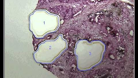 Laser-microdissection of pancreatic ductal adenocarcinoma tissues