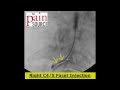 Cervical facet injection under fluoroscopy   thepainsourcecom