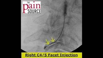 Cervical Facet Injection under fluoroscopy  - ThePainSource.com
