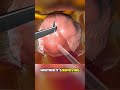 How Craniotomy Brain Surgery Is Done (3D Animation) #brainsurgery #neurosurgery #craniotomy #3d