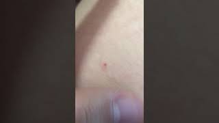 I got stung