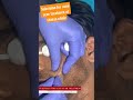 Subcision for acne scar treatment at skinaa clinic subcision subcisionforacnescar shortyoutube