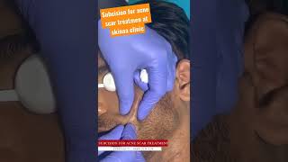 Subcision For Acne Scar Treatment At Skinaa Clinic 