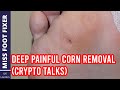 Satisfying Deep Painful Corn Removal Full Treatment By Miss Foot Fixer