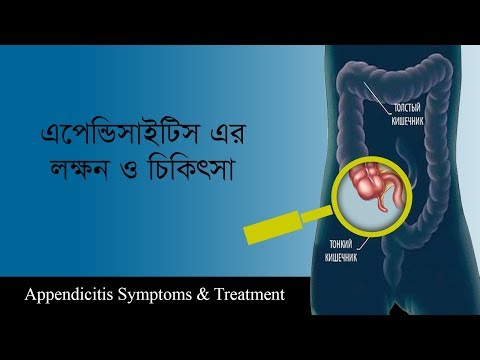 এপেন্ডিসাইটিস এর লক্ষন ও চিকিৎসা পদ্ধতি | Appendicitis Symptoms & Treatment