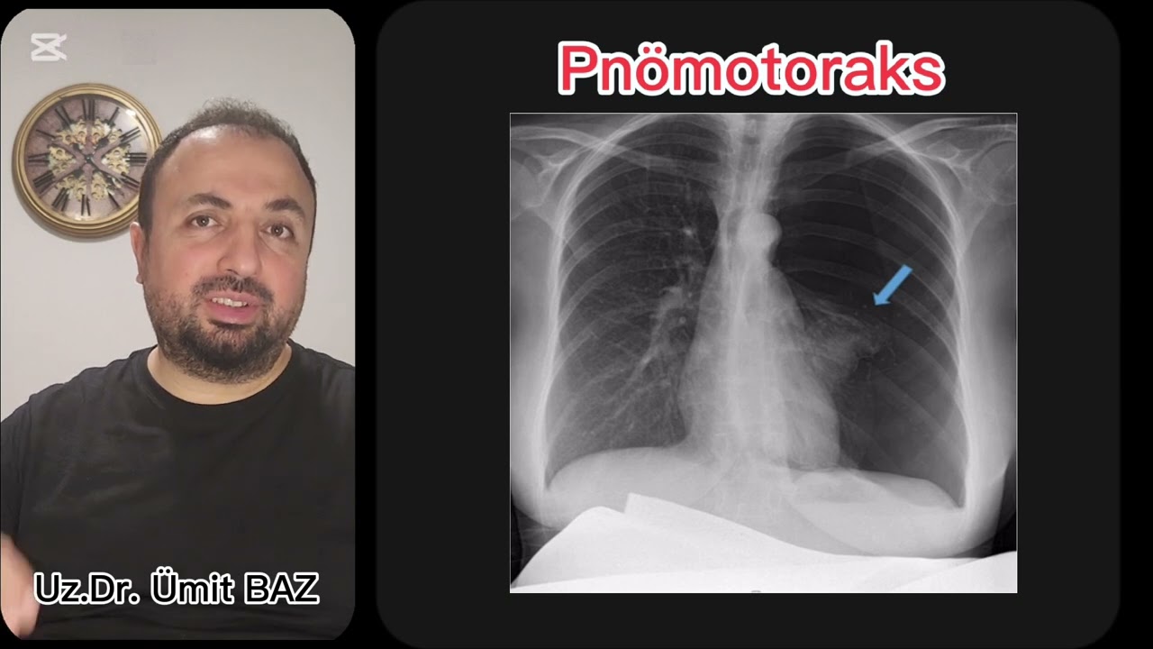 Pnömotoraks ve Hemotoraks