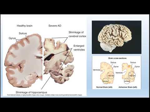 Neurological Disorders