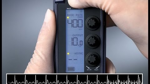 Rapid Atrial Pacing — 53401 Temporary Pacemaker